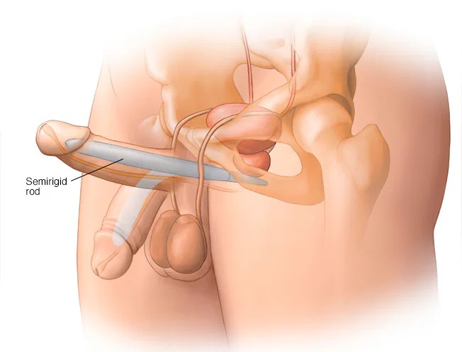 Penile Prosthesis Implant Surgery for Erectile Dysfunction by Dr Uday Bhaskar in JP Nagar Bangalore